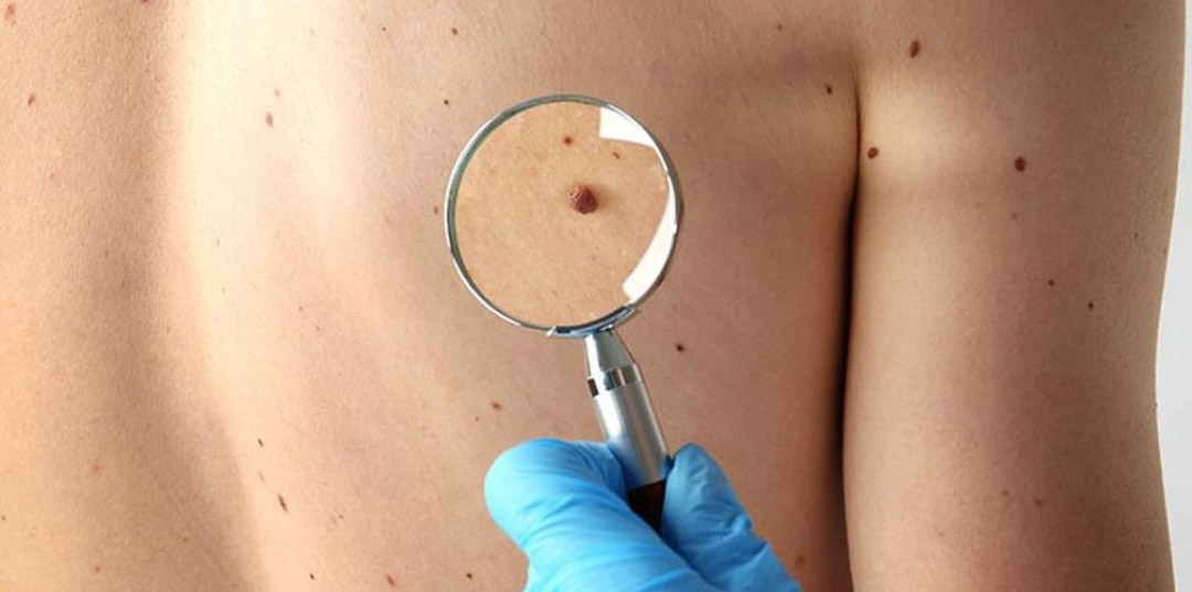 Detección de cáncer de piel en el centro de salud de Villa Primavera