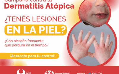 Campaña de atención para niños y adolescentes con dermatitis atópica en el HPMI